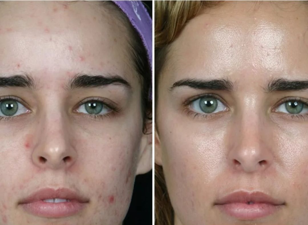 Эффект после лечения. Дезинкрустация (гальваническая чистка лица). Кожа до и после косметолога. Механическая чистки лица жо и после.