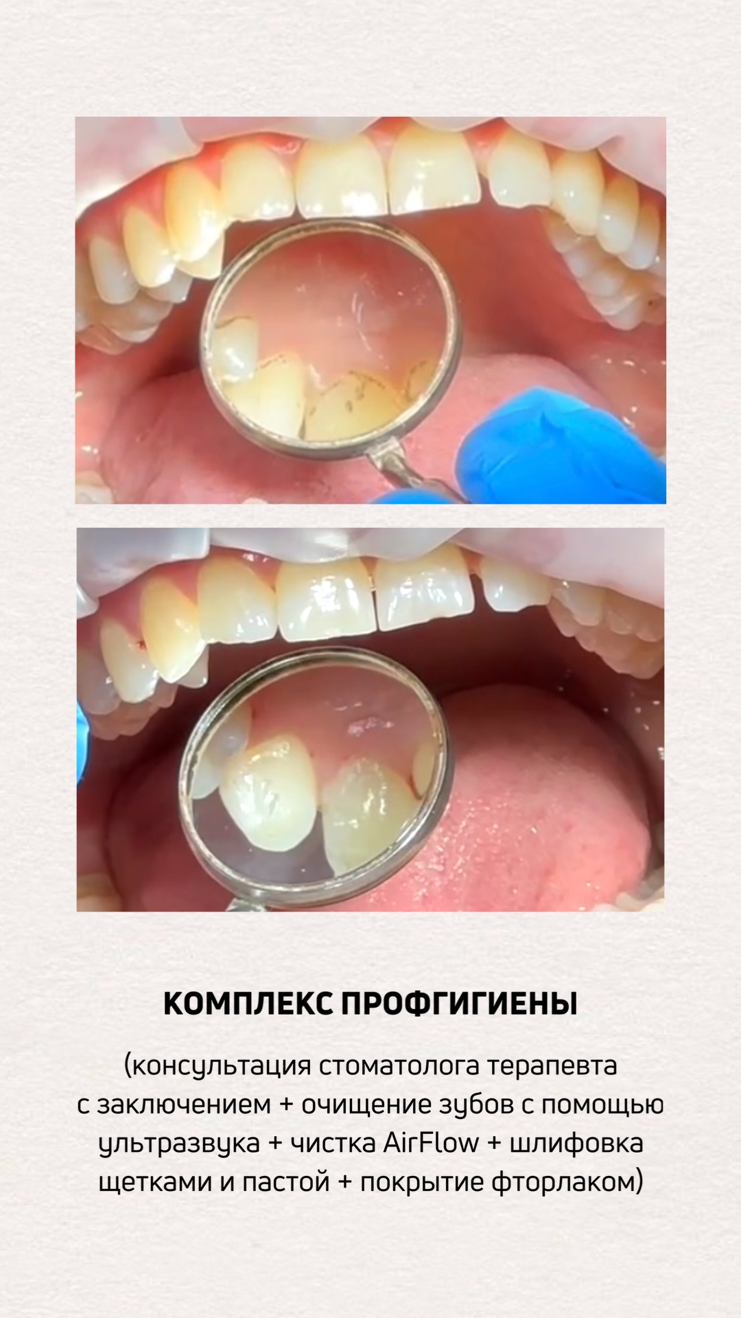 Смотрите, какая акция: уз-чистка зубов, комплекс профгигиены в ...