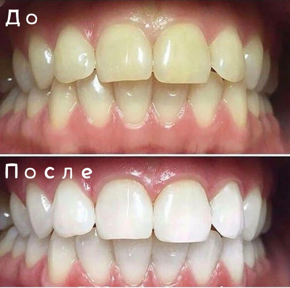 сильное отбеливание зубов до и после