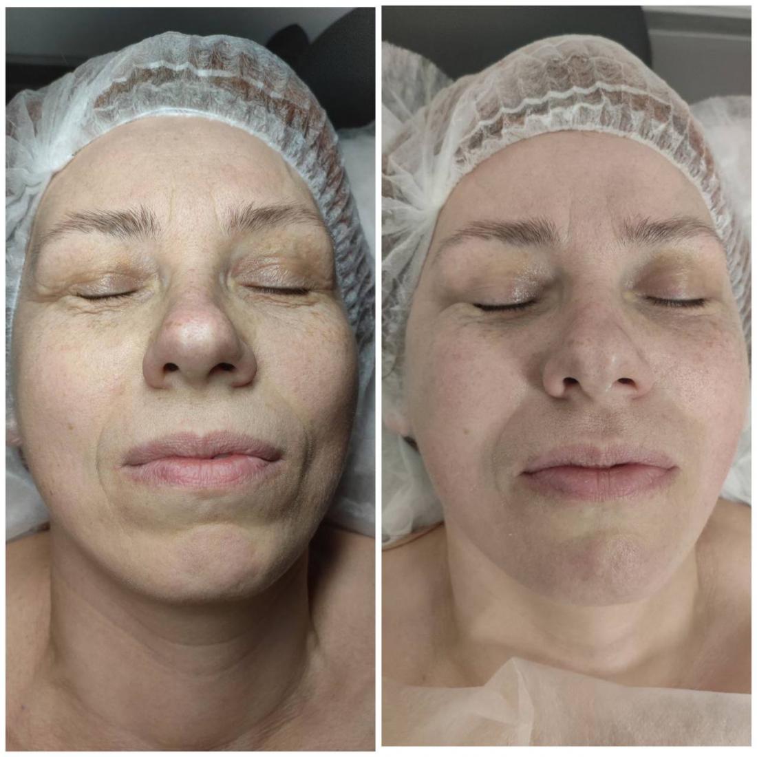 показания к пилингу лица. ультразвуковая чистка лица. показания к проведению пилинга. противопоказания к пилингам химическим. показания к пилингу лица.